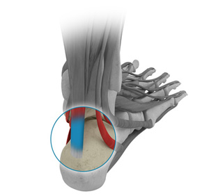 Achilles tendon repair