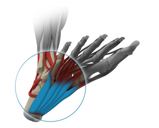 Release of the plantar fascia
