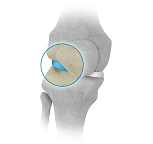 Arthroscopy of the knee, meniscectomy, meniscal repair
