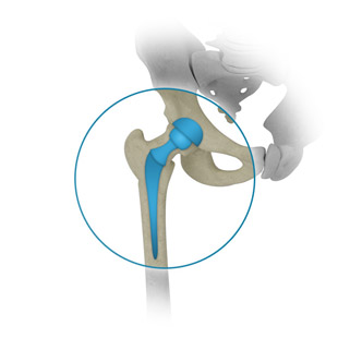 Revision surgery of a total hip replacement
