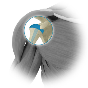 Résultat de recherche d'images pour "Arthroplastie de l’épaule"