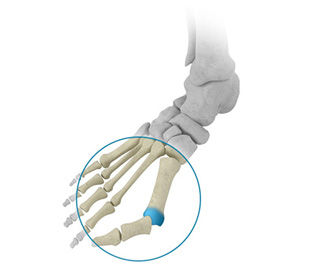 Arthroplastie métatarsophalangienne