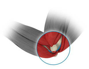 Elbow ligament repair