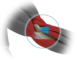 Relâchement tendineux du coude