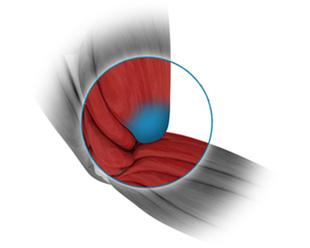 Distal biceps repair