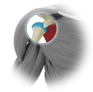 Reconstruction de la coiffe par arthroscopie