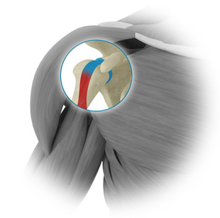 Labrum repair (S.L.A.P.)