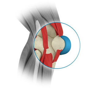 Prepatellar bursectomy