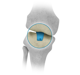 Anterior and posterior cruciate ligament repair