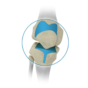 Knee replacement with prosthesis