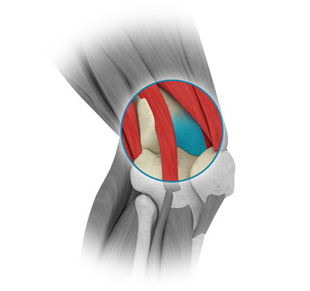 Osteochondritis dissecans repair