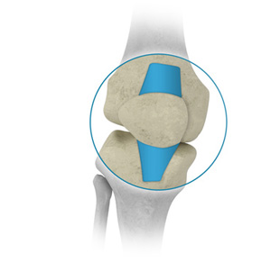 Kneecap stabilization