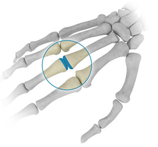 Arthroplastie des doigts