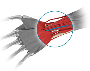 Décompression nerveuse au poignet