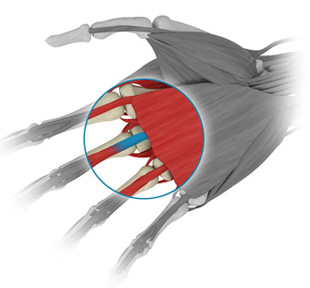 Tendon decompression