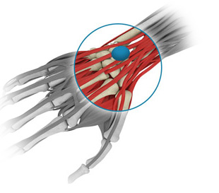 Excision of a cyst